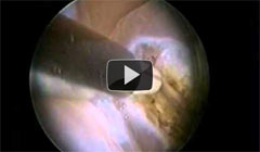 VIDEO: Removal of polyp with Versapoint. 